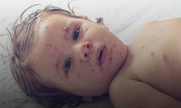 Another child dies with measles symptoms in Sylhet